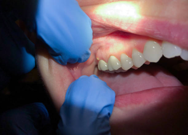 Best Emergency Wisdom Teeth Removal in Suisun City, CA
