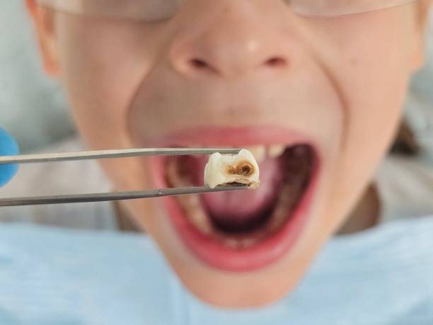 Best Emergency Tooth Extraction in Suisun City, CA